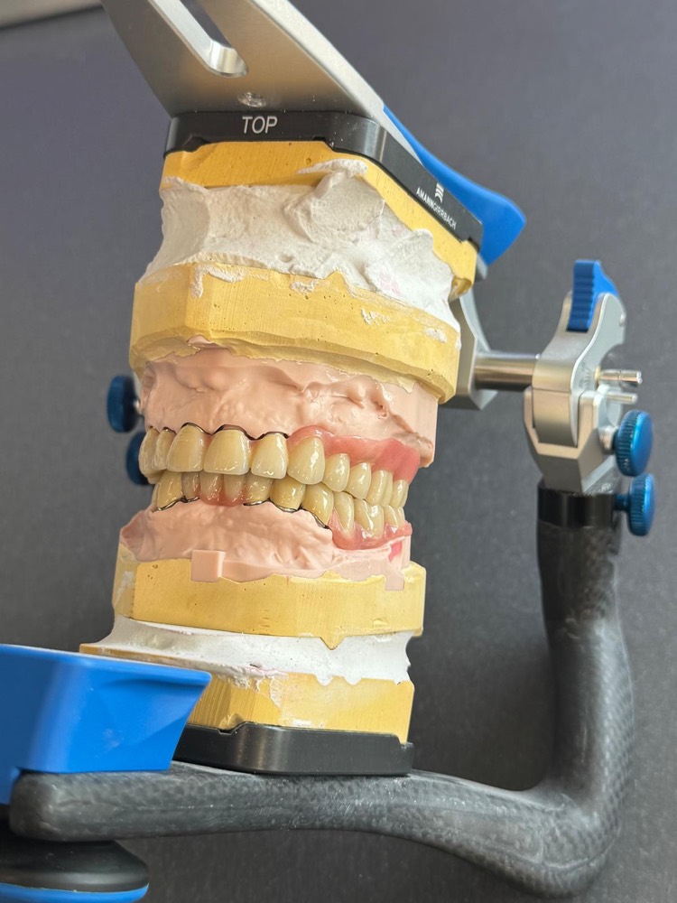Prothese im Artikulator im Dentallabor Kiefer